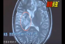 少女大腦皮層萎縮 醫生從她腦子里捉出5cm長蟲子