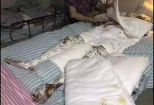 做飯時廚房突爆炸 23歲美女碩士全身70%燒傷