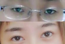 實(shí)地探訪暑期整容熱潮，為什么母親要求我整容？