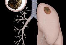 伯克生物抗塵肺1.1類新藥啟動(dòng)Ⅱ期臨床試驗(yàn)