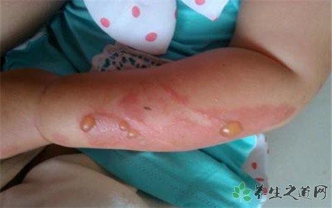 女孩玩火一家燒傷 被大火燒傷怎么辦
