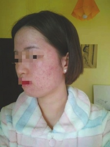 成都蕾特恩專業祛痘怎么樣？推銷陷阱多 81名消費者集體控訴蕾特恩