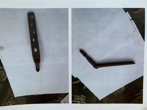 商丘市第一人民醫(yī)院79歲老人手術(shù)后死亡追蹤：用藥記錄“消失” 骨灰中手術(shù)部件有異