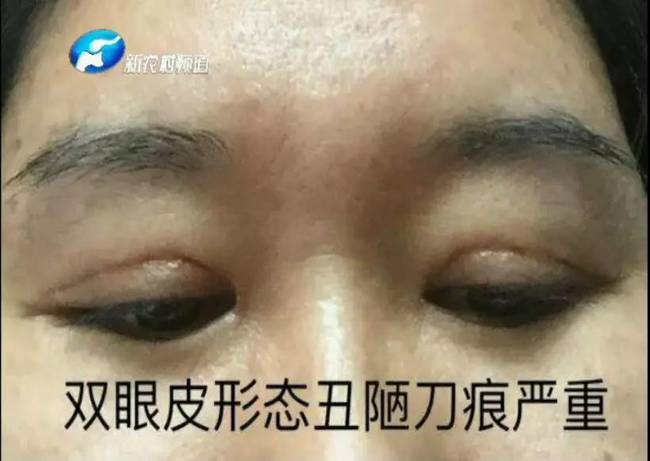 女子整形失敗 許昌華姿醫(yī)美整形醫(yī)院不認(rèn)：因?yàn)獒t(yī)生已離職