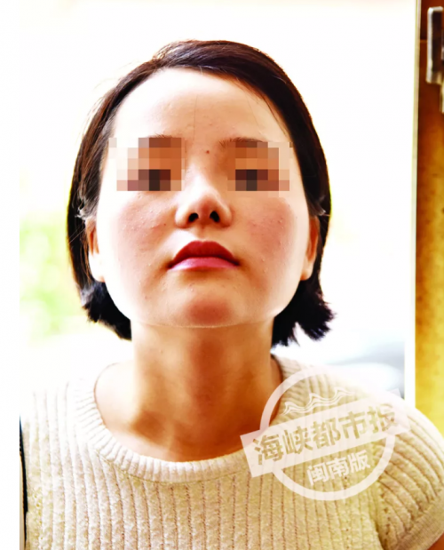 泉州東大整形醫(yī)院被投訴：女子花4.4萬整容 鼻子歪成這樣