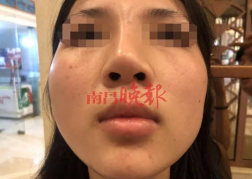 南昌禾麗整形醫院把我鼻子整歪了 記者介入協調才同意免費修復