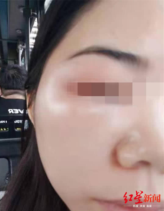女子在宜賓韓美整形后差點毀容 醫院：個體差異