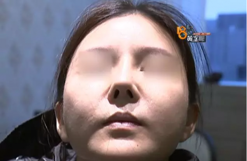 在寧波益寶醫(yī)療美容醫(yī)院整形后鼻孔就沒通暢過 院方：需證明不通與整形有關(guān)