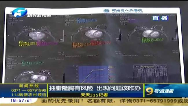 鄭州曹樂醫療整形：抽脂隆胸不靠譜 整出問題溝通難