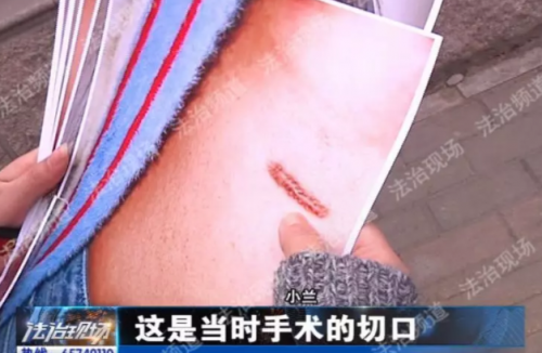 鄭州新生醫院隆鼻失敗 假體往外透院方稱沒法解決