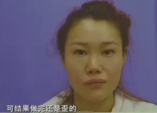 杭州格萊美整形醫(yī)院把美女鼻子成了S型 只敢開美顏拍照