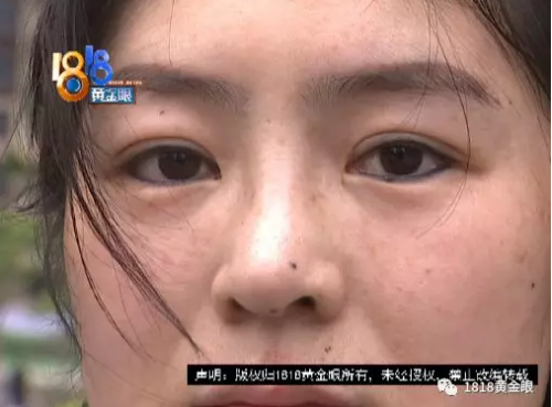 寧波童顏美容整形醫院整形失敗了？女子：被毀容了