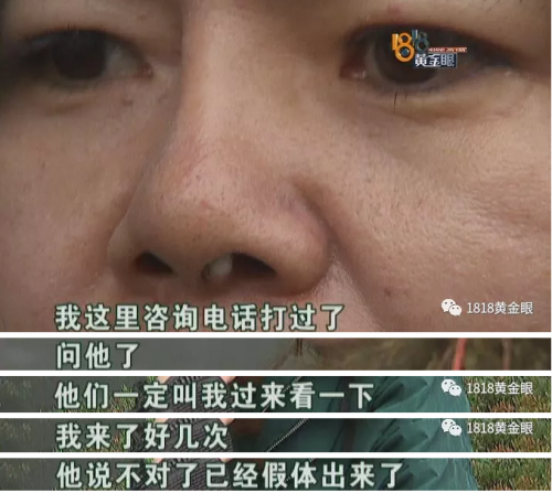 六年前在寧波珈禾整形??漆t院做隆鼻 現在鼻子不舒服露出白色假體-易網<a href=http://www.aoa7937.com/ target=_blank class=infotextkey>健康養生</a>網 六年前在寧波珈禾整形??漆t院做隆鼻 現在鼻子不舒服露出白色假體