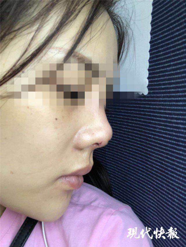 南京怡華醫(yī)療美容醫(yī)院整形失敗 90后姑娘隆鼻后成了“豬鼻子”