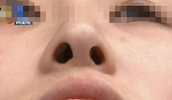 杭州千晴整形醫(yī)院隆鼻后耳后根長(zhǎng)了個(gè)包 鼻孔也一大一小