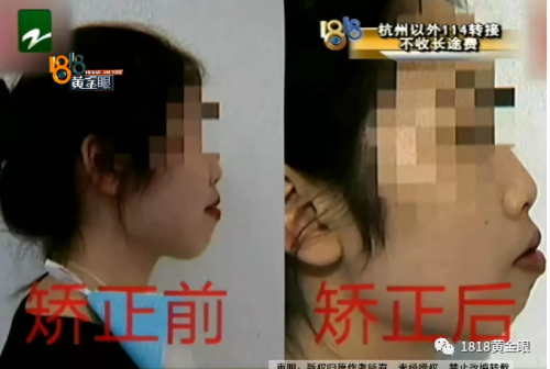 花1.3萬在寧波壹加壹美容醫(yī)院整形 姑娘：嘴巴外凸并沒改善
