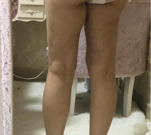 南昌亞太醫(yī)療美容醫(yī)院抽脂手術(shù)后情況很糟糕 女子維權(quán)卻被罵出來
