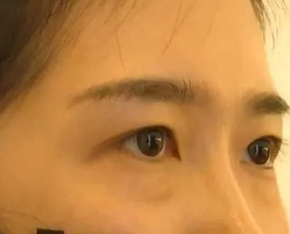 女子在杭州珈禾整形美容醫院打熊貓針結果變成熊貓眼？