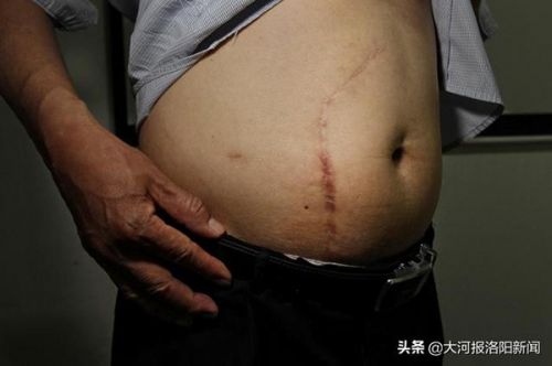 13年前只在洛陽市商業(yè)職工醫(yī)院做過一次闌尾手術(shù) 為何膽囊不見了？