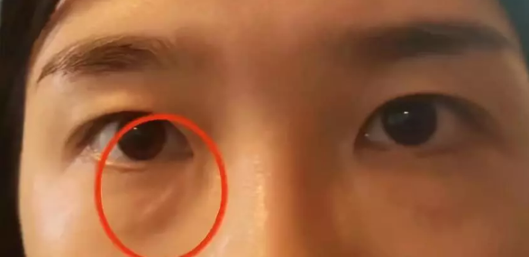 女子在杭州珈禾整形美容醫院打熊貓針結果變成熊貓眼？