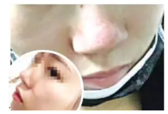 泉州逸膚中醫皮膚病醫院激光祛痘坑失敗 院方：已辦理退款