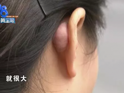 杭州千晴整形醫(yī)院隆鼻后耳后根長了個包 鼻孔也一大一小