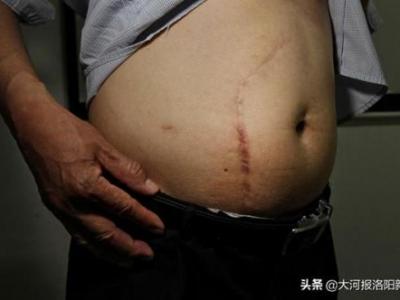 13年前只在洛陽(yáng)市商業(yè)職工醫(yī)院做過(guò)一次闌尾手術(shù) 為何膽囊不見(jiàn)了？