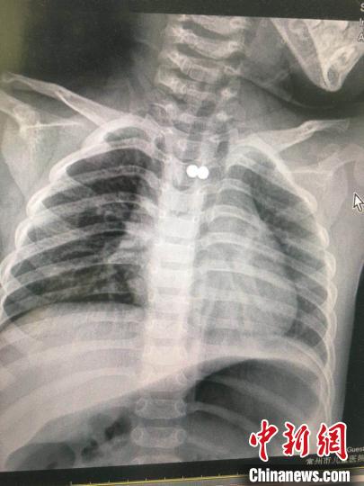 男童誤食兩顆磁力珠 專家通力配合將磁力珠取出-易網<a href=http://www.aoa7937.com/ target=_blank class=infotextkey>健康養(yǎng)生</a>網 男童誤食兩顆磁力珠 專家通力配合將磁力珠取出