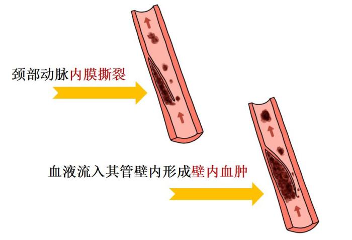【醫(yī)線觀察】按摩拉伸、拔火罐、“種草莓”會得腦中風(fēng)？