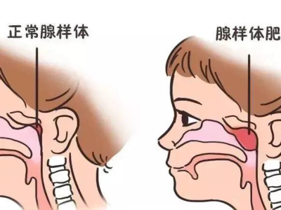 孩子需要做腺樣體手術嗎？醫生教你判斷手術指征