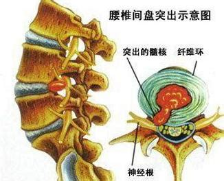 久坐族注意！腰疼腿麻不是小事，腰椎間盤突出癥防治指南請收好
