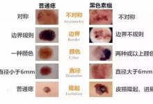 身上的痣千萬不要亂摳！痣的5個惡變信號，你有嗎？