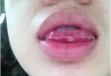 口腔潰瘍痛到發(fā)瘋，3個小妙招可快速治愈