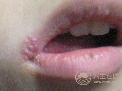 吃這些食物讓你嘴巴不上火起泡! 吃這些食物讓你嘴巴不上火起泡!