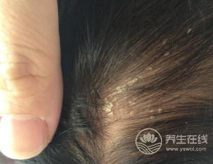 頭皮屑多很尷尬？不妨多吃這幾種食物