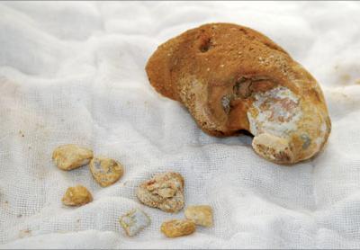 體內(nèi)有結(jié)石的患者吃什么菜對(duì)身體最好