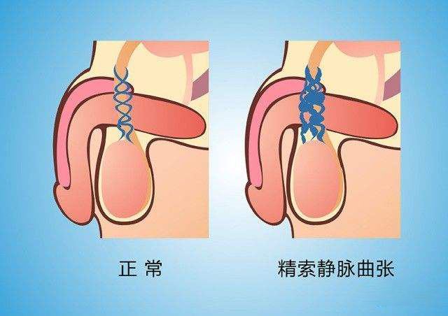 靜脈曲張患者的腿部水腫治療方法