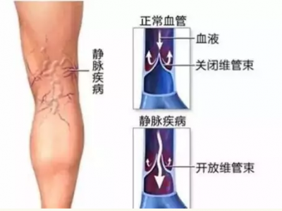 喝酒是否會(huì)影響到靜脈曲張患者的健康