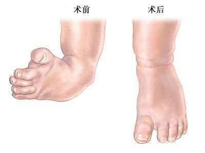 導致孩子足內(nèi)翻的因素以及改善方法