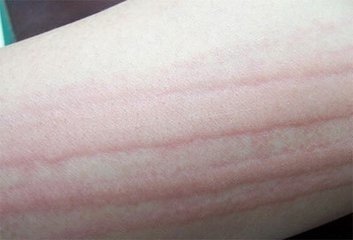 劃痕性蕁麻疹身體需要補充哪些營養