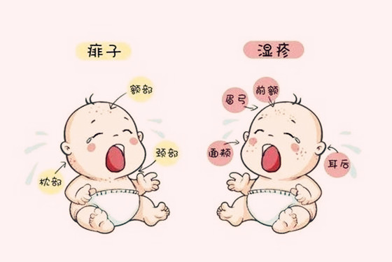 濕疹和蕁麻疹具體存在著哪些區別