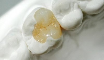 補完牙齒之后過多久可以開始吃東西