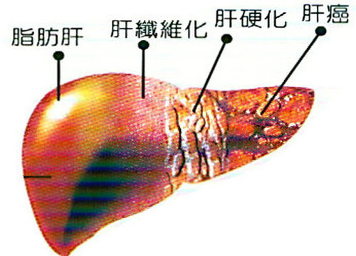 脂肪肝前期表現以及脂肪肝的預防方法