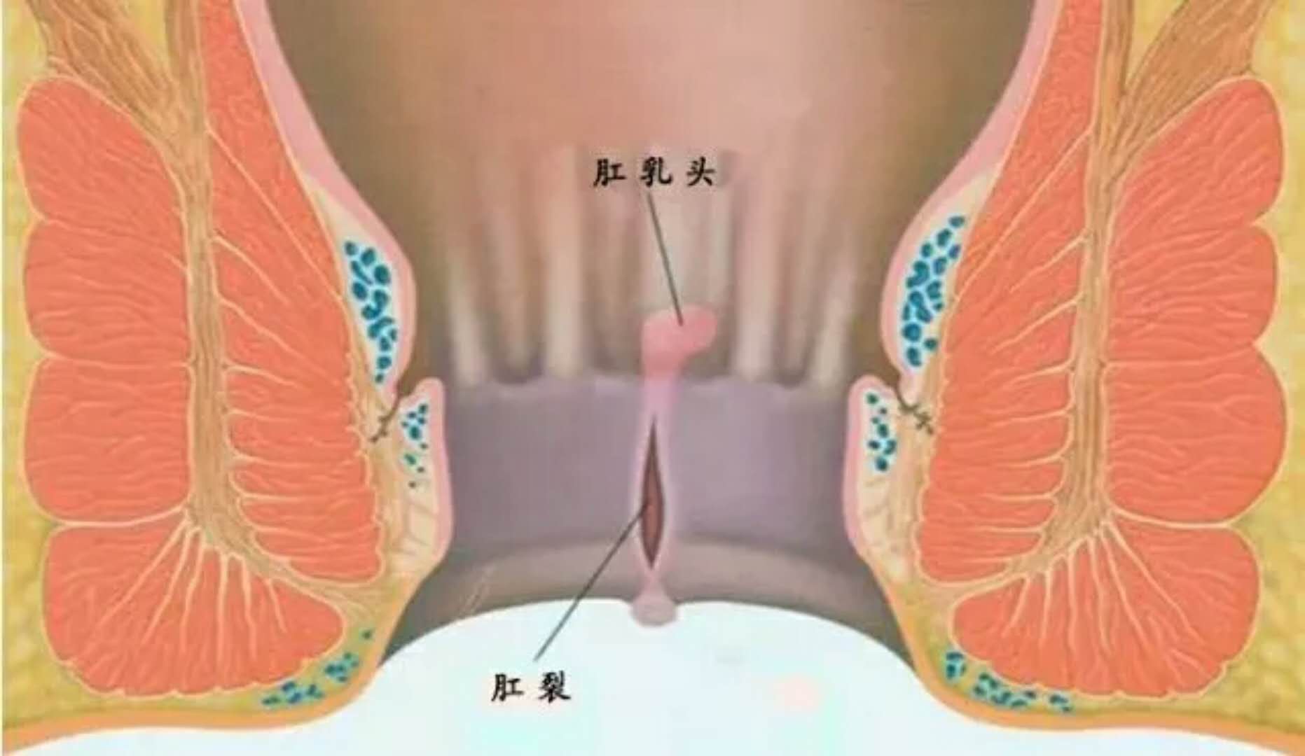 四種肛腸疾病即將出現的早期癥狀
