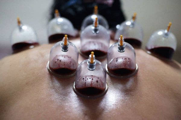 為什么拔罐之后會出現黑色水泡和血泡