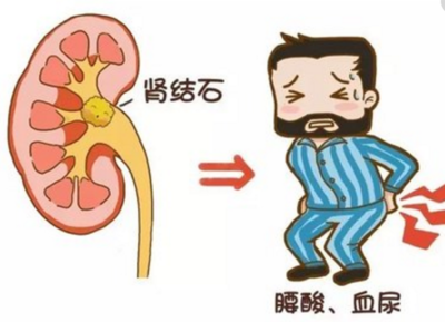 腎結石疼痛難忍這個的飲食原則有助于排石