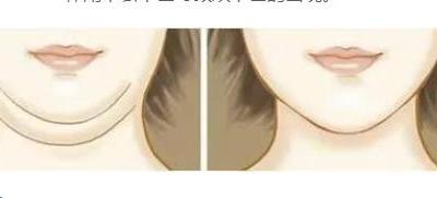 為什么會長雙下巴的幾種原因