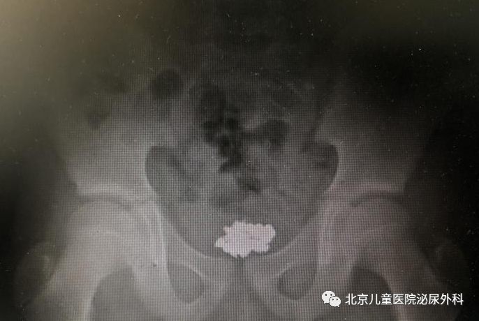 大夫，寶寶把東西塞進下面了！怎么辦？