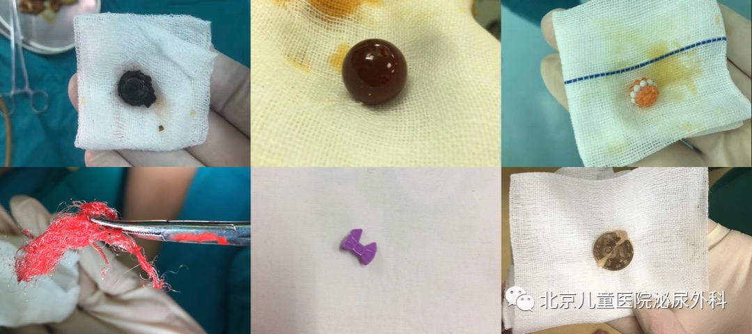 大夫，寶寶把東西塞進下面了！怎么辦？