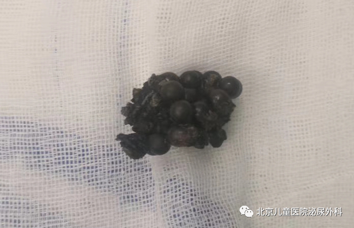 大夫，寶寶把東西塞進下面了！怎么辦？
